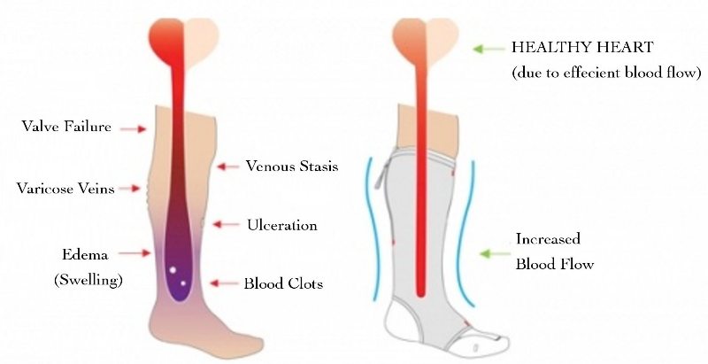 How Long Should You Wear Compression Socks For Better Blood Circulatio –  Lasso® UK by HOL