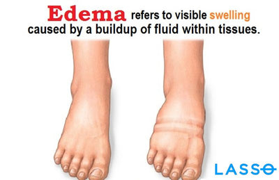 Edema: Causes, Symptoms & Treatment
